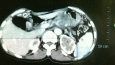 刀绞似的胃痛，原来病根不在胃里面” ——肝胆外科完成一例高难度胰体尾肿瘤切除手术