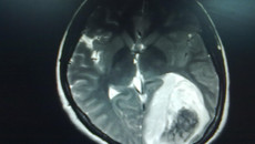 一附院外六科中西医结合成功救治一恶性脑肿瘤并脑疝危重患者