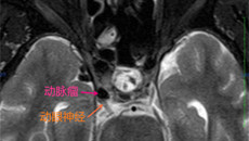 颅内疾患致失明，重见光明有绝招