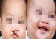 唇腭裂患者的福音：美国微笑列车项目携手瑞康医院“让天使绽放美丽微笑”