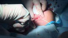 一附院开展手臂式输液港植入术为患者带来福音