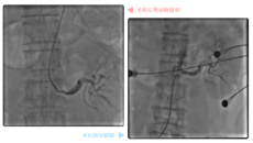 万全准备、分次实施。国壮心病科成功拿下这台高风险、高难度手术！