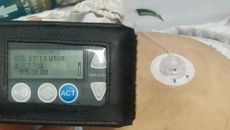 术后创口难以愈合，专科医生上了这款“神器”