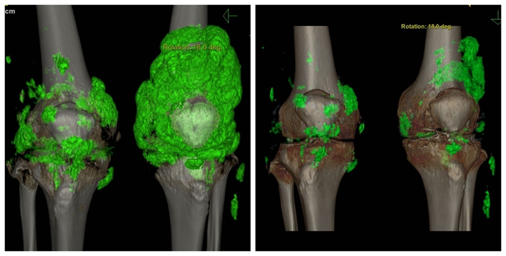 2020年7月（左）与2023年7月（右）双膝能谱CT检查对比图，痛风结晶明显减少。