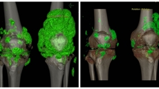 【附属国际壮医医院】痛风只找中老年人？错！有这些喜好的青少年一定要注意！