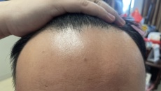 【附属国际壮医医院】就，太“秃”然了，怎么办？